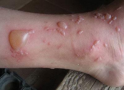 Эритематозно-буллезный дерматит