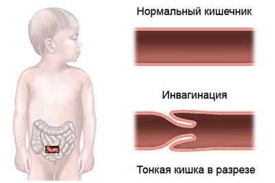Инвагинация кишечника