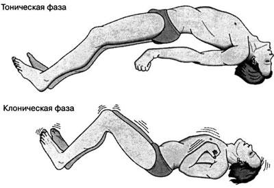 Фазы эпилептического припадка