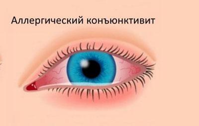 Аллергический конъюнктивит