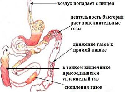 Образование газов в ЖКТ