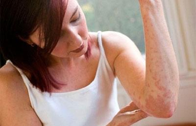 Крапивница на руке