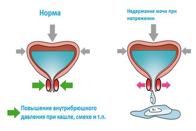Нейрогенное недержание мочи