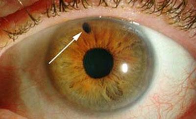 Проявление глаукомы