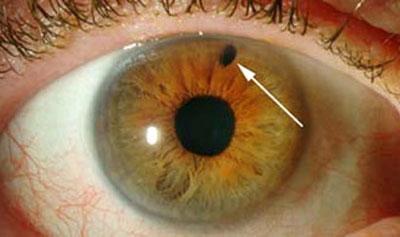 Проявление глаукомы