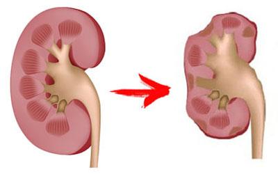 Почечная недостаточность