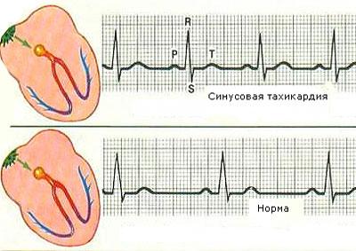 Сердечный ритм при тахикардии