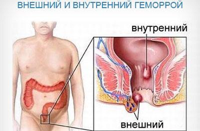 Виды геморроя