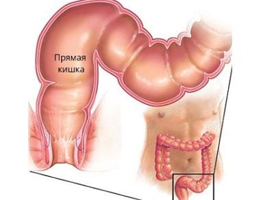 Прямая кишка