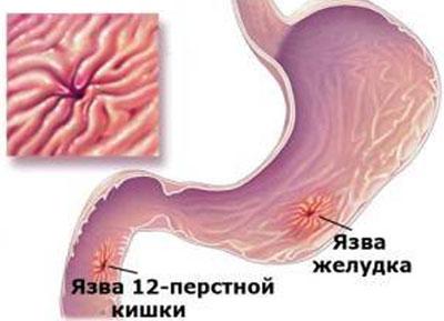 Язвенная болезнь
