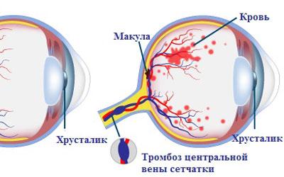Тромбоз вены сетчатки