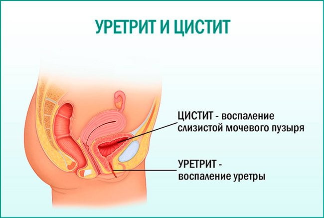 Уретрит и цистит