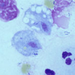 Urogenitalnyj-trihomoniaz-150x150.jpg