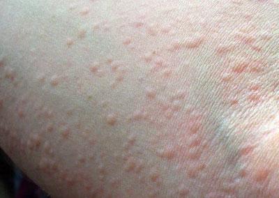 Сыпь при крапивнице