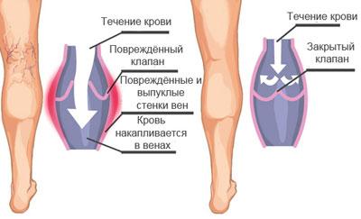 Проявление варикоза