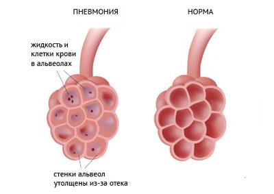 Легкие при воспалении