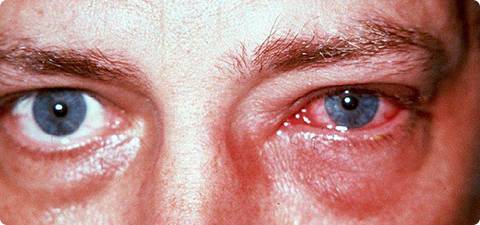 лечение электроофтальмии