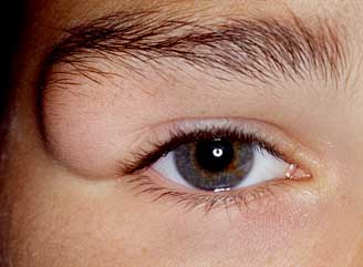 удаление кисты