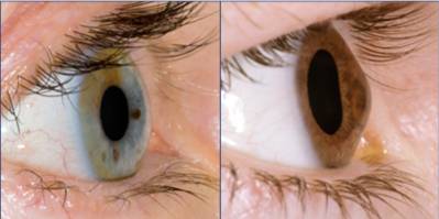 внешний вид кератоконуса