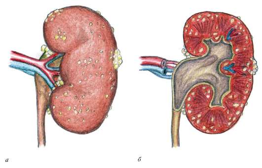 Почки при пиелонефрите