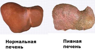 Алкогольный гепатит