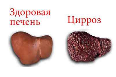 Цирроз печени
