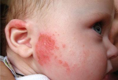 Аллергия на витамин с