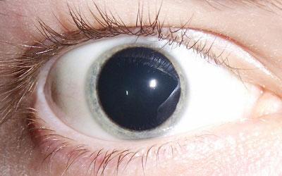 Расширение зрачка