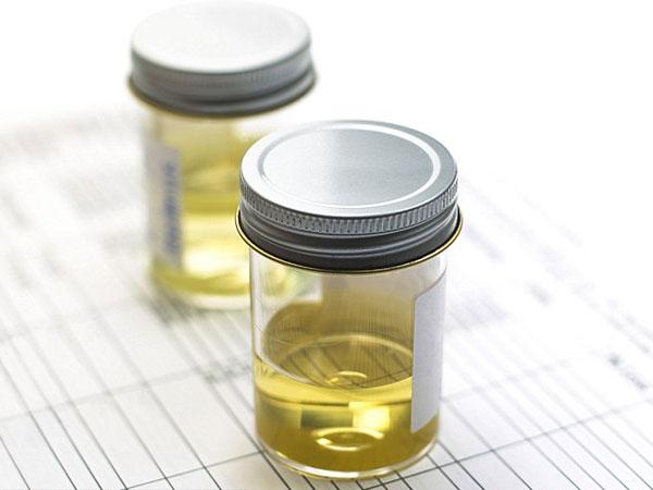 Общий анализ мочи