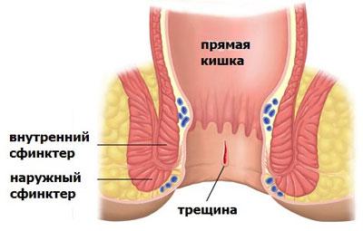 Анальная трещина
