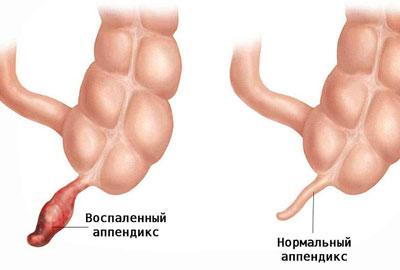 Воспаленный аппендикс