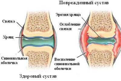 Сустав при артрите