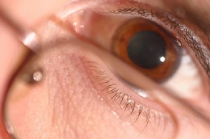 astigmatism_treatment