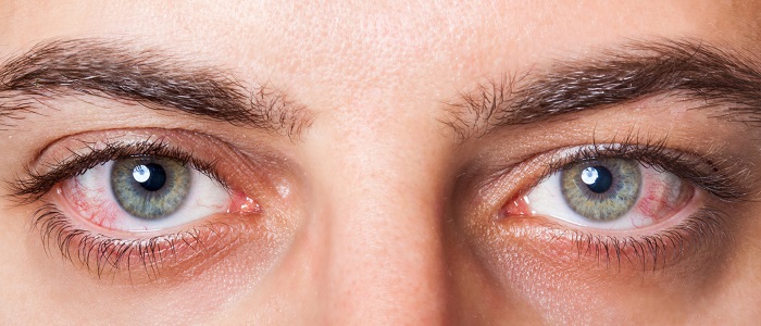 тромбоз глаза