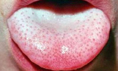 Белый налет на языке