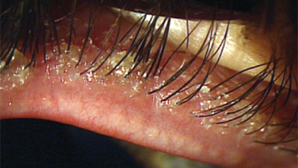 blepharitis