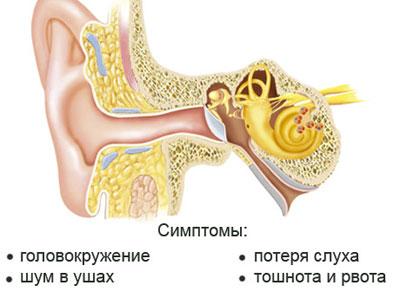 Симптомы болезни Меньера