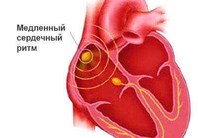 Симптом брадикардии