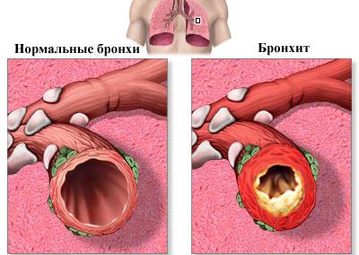 Проявление бронхита