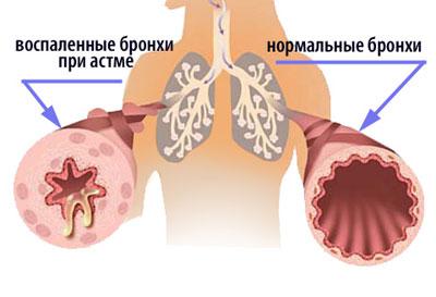 Бронхи при астме