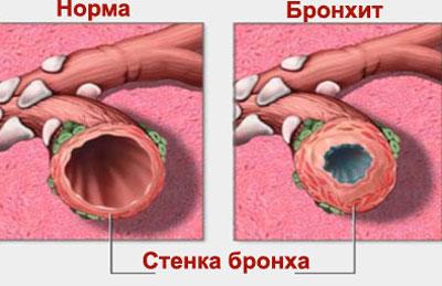 Заболевание бронхит