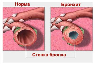 Хронический бронхит