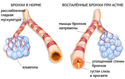 Бронхи при астме