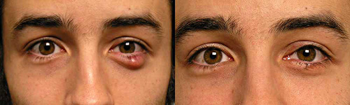 воспаление века