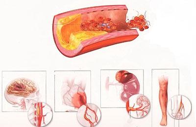 Атеросклероз сосудов