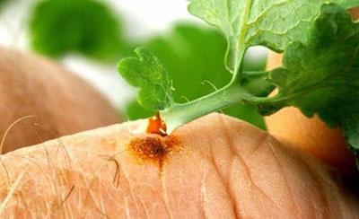 Удаление бородавки соком чистотела