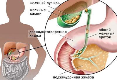 Причины холецистита