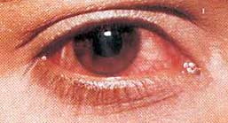 бактериальный конъюнктивит