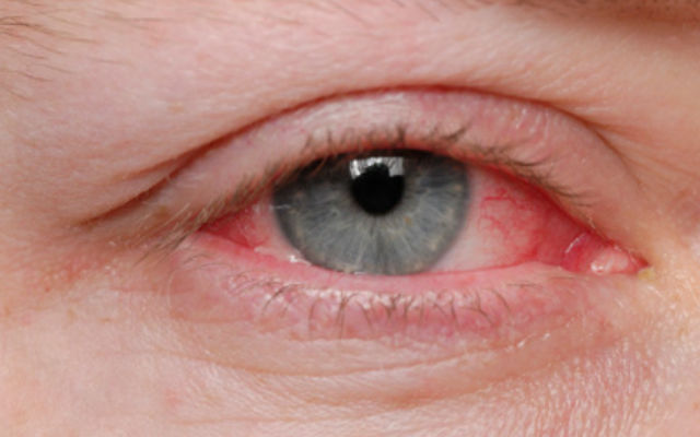 лечение красных глаз