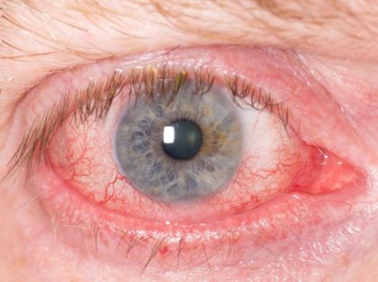 демодекоз глаза